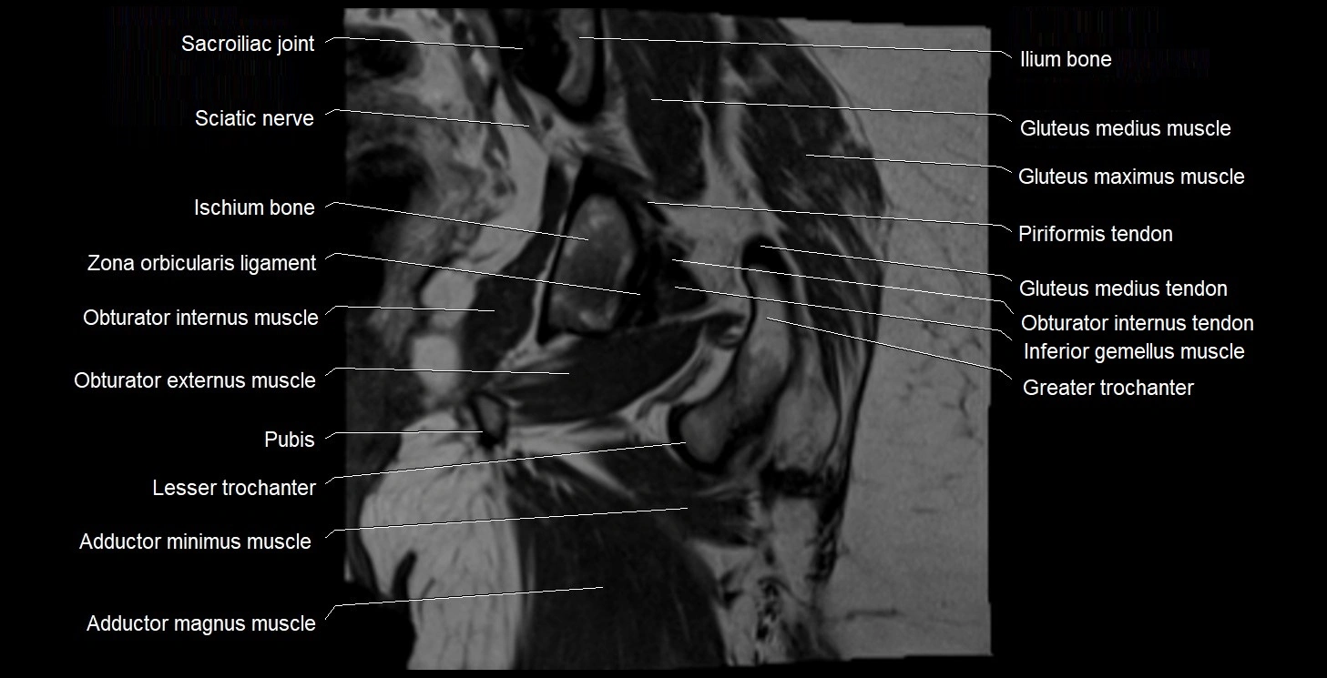 MRI Hip 3T coronal cross sectional anatomy image 42.webp